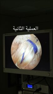 تدريسي في كلية طب المستنصرية يقوم باجراء ثلاث عمليات ناجحة لزراعة الرباط الصليبي الأمامي