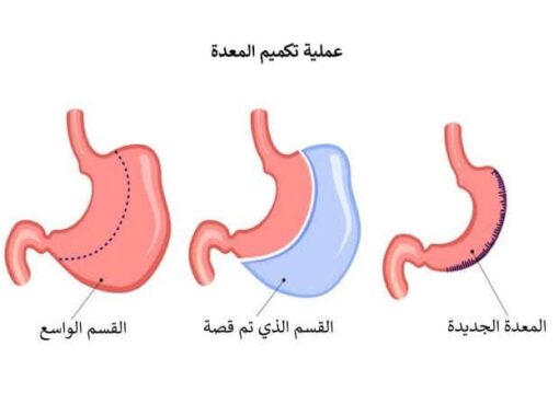 أيهما أفضل لمواجهة " السمنة المفرطة "ربط المعدة أم التكميم  استشارية تجيب