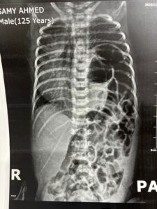 نجاح جراحة دقيقة بمستشفى الفيوم العام لإنقاذ رضيع عمره 9 أيام من فتق خلقي بالحجاب الحاجز