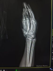 ​إنجاز طبي مذهل لجامعة سوهاج بإعادة إصبع مبتور لشاب في جراحة معقدة