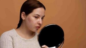 حبّ الشباب في الشتاء.. أسباب خفية وحلول فعّالة لبشرة صحية