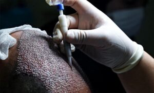 رامي شيحة….زراعة الشعر في مصر تطور مذهل ينافس تركيا