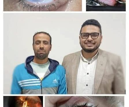 مستشفيات جامعة بني سويف تنجح في إنقاذ عين مريض من العمى بجراحة نادرة ومعقدة