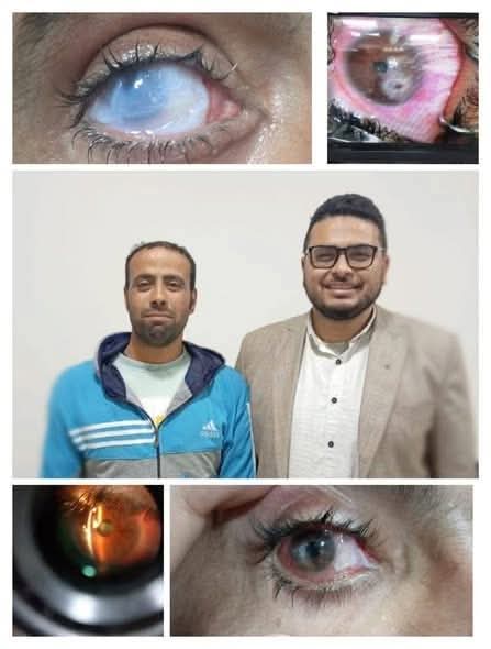 مستشفيات جامعة بني سويف تنجح في إنقاذ عين مريض من العمى بجراحة نادرة ومعقدة