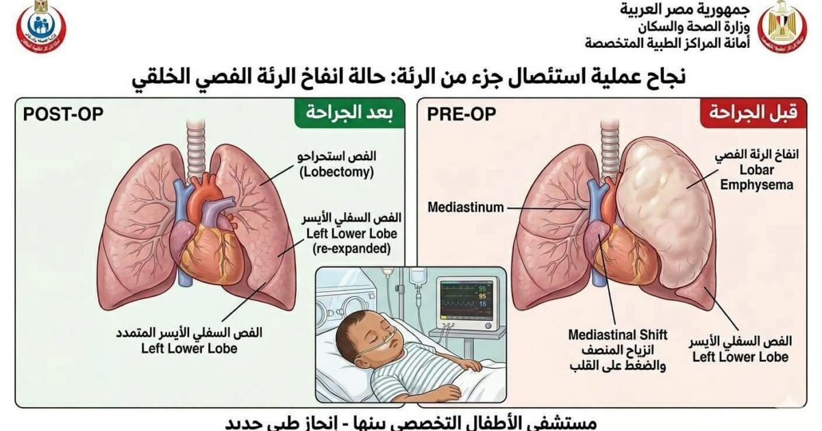 إنقاذ حياة طفل بعملية استئصال جزء من الرئة 