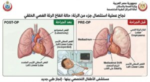 إنقاذ حياة طفل بعملية استئصال جزء من الرئة 
