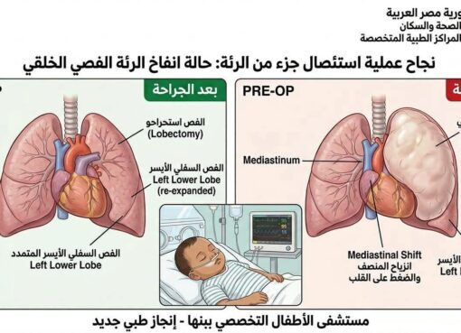 إنقاذ حياة طفل بعملية استئصال جزء من الرئة 