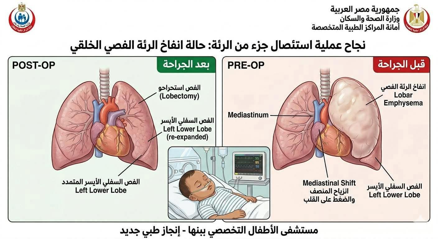 إنقاذ حياة طفل بعملية استئصال جزء من الرئة 